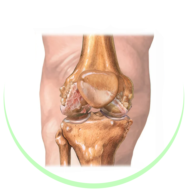 Arthritis & Joint Pain
