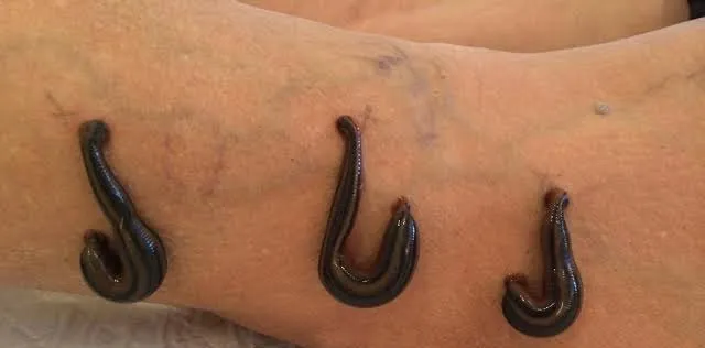 Jalaukavacharana Leech Therapy
